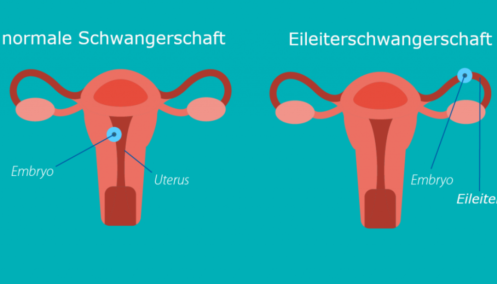 eileiterschwangerschaft