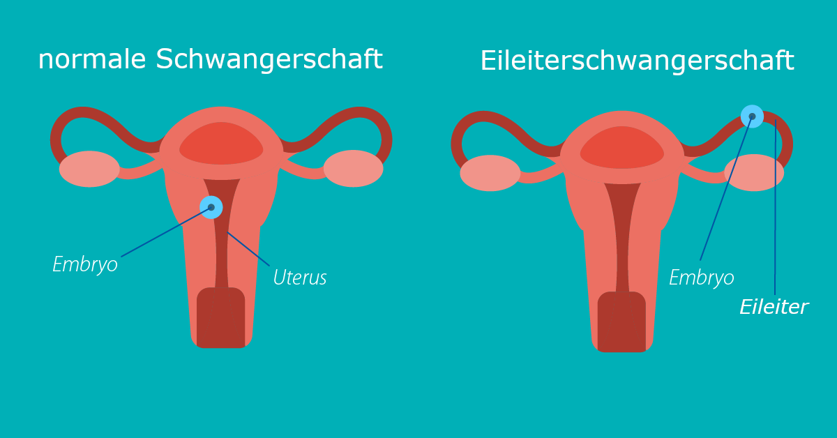 eileiterschwangerschaft