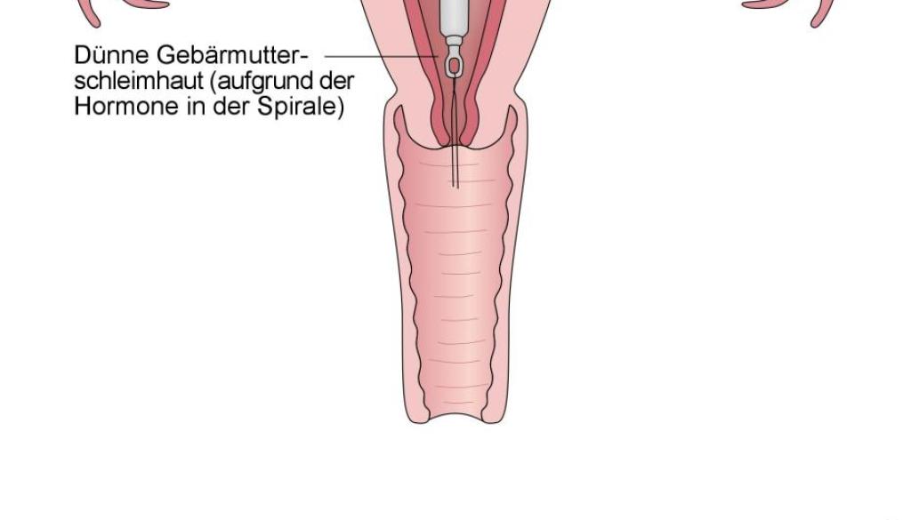 Gebaermutter mit Hormonspirale